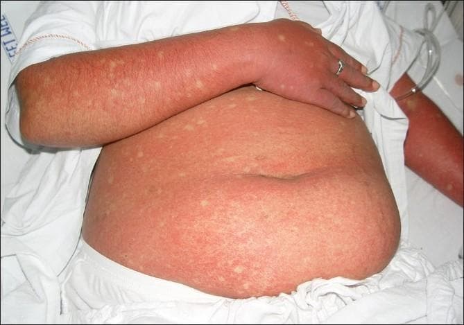 This clinical photograph displays a patient's abdomen and arm presenting a generalized, confluent erythematous rash, a characteristic cutaneous manifestation of Dengue Fever. The exanthem is marked by widespread, intense redness resulting from capillary dilatation and coalesced maculopapular lesions. A diagnostic hallmark visible here is the presence of 'islands of sparing'—small, rounded, or oval-shaped patches of normal-colored skin scattered throughout the erythematous background, often described as 'white islands in a sea of red'. These spared areas are randomly distributed across the affected trunk and limbs. The image serves as a key educational reference for recognizing the secondary rash phase of Dengue viral infection, typically occurring 3 to 6 days after the onset of fever. The visual presentation is essential for clinical diagnosis and differentiation from other viral exanthems, highlighting the specific immunologic response patterns seen in Dengue Fever (DF) and Dengue Hemorrhagic Fever (DHF).