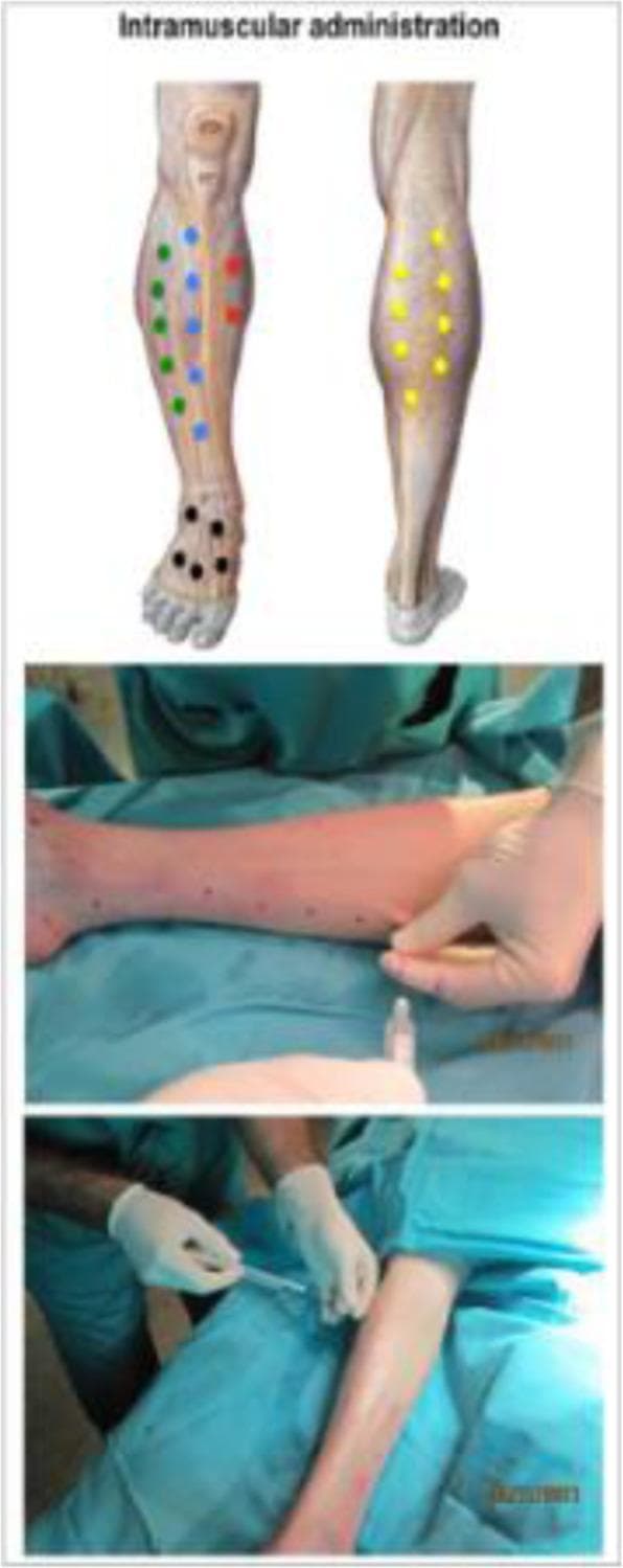 A composite clinical figure titled 'Intramuscular administration' illustrating the procedure for cell therapy in a patient's lower limb. The upper panel contains two anatomical diagrams of the lower leg showing targeted muscular injection points. The left diagram displays a multi-colored distribution of injection sites: green dots on the lateral calf, blue dots centrally, red dots medially, and black dots on the dorsal foot. The right diagram shows yellow dots distributed along the gastrocnemius muscle. The lower panels are clinical photographs depicting the real-world application of this protocol. The middle panel shows a patient's leg positioned horizontally on a blue sterile drape, with the skin pre-marked with dark dots for guidance. A medical professional in white gloves is seen prepping the site. The bottom panel shows the actual administration, where the professional is performing a minimally invasive intramuscular injection using a syringe. This visual serves as a guide for standardized adipose-derived mesenchymal stromal cell (Ad-MSC) delivery in clinical trials for conditions like critical limb ischemia (CLI).