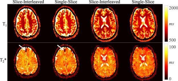 A comparison of axial brain MRI maps acquired using magnetic resonance fingerprinting (MRF) echo-planar imaging (EPI). The image displays two rows: the top row shows T1 relaxation maps (0–2000 ms) and the bottom row shows T2* relaxation maps (0–100 ms). Each row compares two acquisition techniques: 'Slice-Interleaved' and 'Single-Slice'. The T1 maps demonstrate clear anatomical contrast with white matter appearing in darker red tones (lower T1 values) and grey matter in lighter yellow tones (higher T1 values). The T2* maps provide susceptibility contrast weighting. A focal signal dropout in the frontal lobe, indicated by white arrows in both the slice-interleaved and single-slice T2* maps, identifies a region of intracranial calcification. The color-coded scale bars on the right quantify the relaxation times in milliseconds. The visual comparison highlights that the slice-interleaved technique achieves comparable image quality, tissue delineation, and pathology detection to the standard single-slice method.