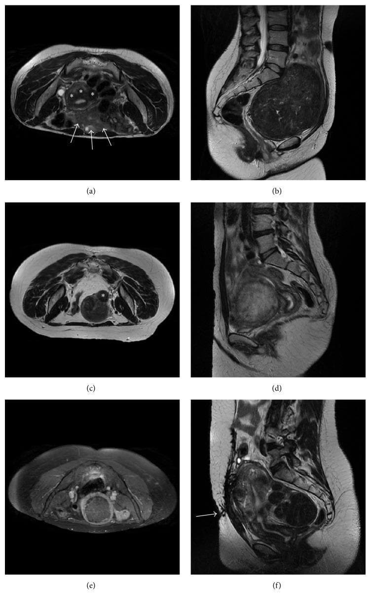 This composite of magnetic resonance imaging (MRI) scans illustrates various clinical presentations of uterine fibroids (leiomyomas) that impact suitability for magnetic resonance-guided focused ultrasound (MRgFUS). (a) Axial T2-weighted MRI shows small, hypointense intramural fibroids (asterisks) with multiple bowel loops (arrows) interposed between the abdominal wall and the uterus, presenting a risk of thermal injury to the bowel. (b) Sagittal T2-weighted MRI displays a massive fibroid occupying the pelvis, noted for its proximity to the sacrum and nerves. (c) Axial T2-weighted MRI identifies a small, pedunculated subserosal fibroid (asterisk). (d) Sagittal T2-weighted MRI depicts a 'bright' hyperintense cellular fibroid, which typically responds poorly to thermal ablation. (e) Axial T1-weighted fat-saturated post-contrast image reveals a non-enhancing fibroid, indicating pre-existing avascularity. (f) Sagittal T2-weighted MRI highlights a bulky abdominal wall scar (arrow), which can distort or absorb ultrasound energy during treatment. The collection serves to teach screening criteria, focusing on size, location, signal intensity, enhancement patterns, and acoustic window accessibility.