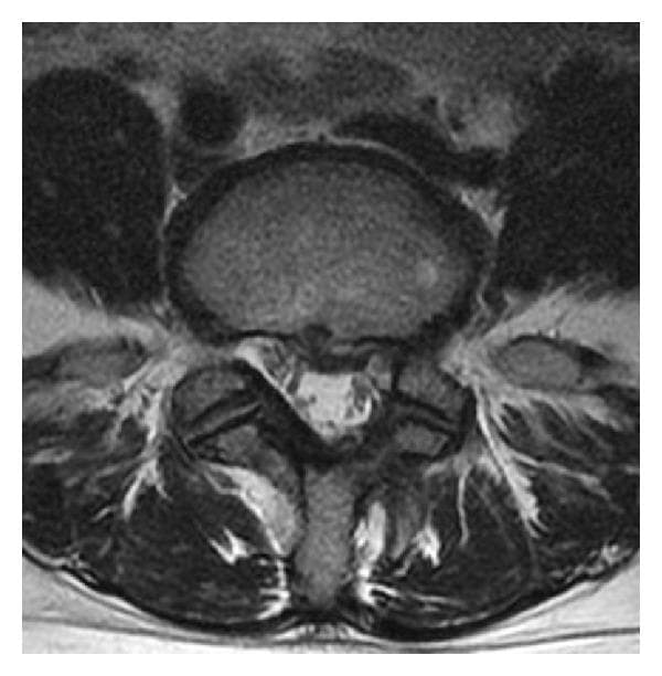 An axial-view T2-weighted magnetic resonance image (MRI) of the lumbar spine at the L4-L5 level. The image demonstrates a herniated nucleus pulposus (HNP) situated in the left lateral recess. The herniation presents as a soft-tissue protrusion extending from the intervertebral disc into the spinal canal, causing significant focal compression and displacement of the left L5 nerve root. Visible anatomical landmarks include the anterior vertebral body, the central spinal canal, the neural foramina, and the posterior elements including the lamina and spinous process. High-intensity signal suggests the acute or recurrent nature of the disc material. This diagnostic image illustrates common pathophysiology associated with lumbar radiculopathy and sciatica, specifically highlighting how localized disc displacement results in neurovascular compromise within the lateral recess.