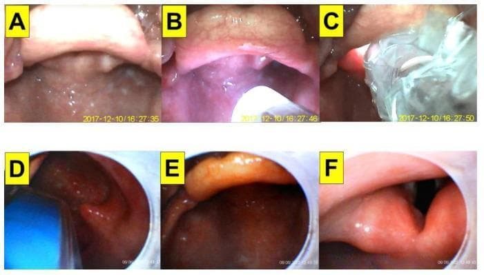 This clinical image sequence demonstrates the 'video-twin' intubation technique, combining videolaryngoscopy (VL) with a video-assisted intubating stylet (VS) in a patient with a cervical spine injury and Mallampati class III airway. Panels A–C show the external videolaryngoscopic perspective. (A) Initial view of the posterior pharynx and base of the tongue. (B) Insertion of the intubating stylet into the oropharyngeal space, facilitating the lifting of the tongue root. (C) Further advancement of the stylet toward the laryngeal inlet, though the view is partially obscured by secretions. Panels D–F provide the internal perspective from the tip of the intubating stylet. (D) Approaching the epiglottis with the blue stylet tip visible. (E) Clearer visualization of the epiglottis as the stylet is maneuvered. (F) Direct visualization of the glottic opening and vocal cords, allowing the endotracheal tube to be advanced into the trachea under direct vision. This dual-view approach is used to manage difficult airways by improving laryngeal exposure and confirming tube placement in real-time.