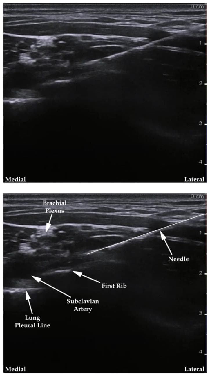 Two-panel diagnostic ultrasound image demonstrating an ultrasound-guided supraclavicular brachial plexus nerve block. The top panel shows the raw sonogram, while the bottom panel includes labels identifying key anatomical landmarks and the procedural needle. In a medial-to-lateral orientation, the image displays the hyperechoic lung pleural line, the anechoic subclavian artery, and the hyperechoic first rib. The brachial plexus is visualized as a cluster of hypoechoic 'honeycomb' structures located superior and lateral to the subclavian artery. A bright, hyperechoic needle is depicted entering from a lateral-to-medial trajectory (in-plane technique), with the tip advancing toward the brachial plexus sheath. This image illustrates the regional anesthesia approach to the upper extremity, highlighting the importance of identifying the 'corner pocket' between the artery and the first rib while avoiding the underlying pleura to prevent pneumothorax. A depth scale on the right indicates the target structures are approximately 1-2 cm from the skin surface.