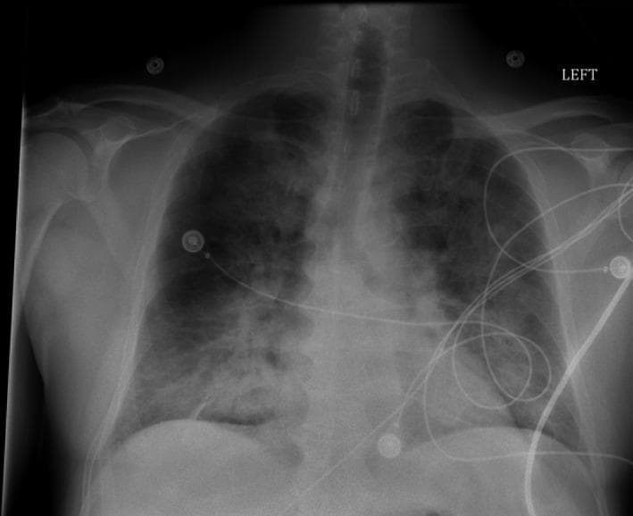 Anteroposterior (AP) chest radiograph demonstrating diffuse, bilateral, 'fluffy' pulmonary infiltrates. The opacities are distributed throughout both lung fields, showing a poorly defined, hazy morphology characteristic of alveolar edema or acute respiratory distress syndrome (ARDS). The cardiac silhouette appears moderately enlarged, though assessment is limited by the AP projection and the extent of overlying pulmonary disease. Multiple medical devices are visible, including several circular EKG leads on the chest wall and various coiled monitoring lines/cables traversing the thorax. A radiopaque 'LEFT' marker is positioned in the upper right corner of the frame. The image illustrates a critical care clinical scenario where pulmonary consolidation and widespread infiltrates correlate with severe respiratory distress. Key educational features include the recognition of diffuse bilateral opacities and the differentiation between cardiogenic and non-cardiogenic pulmonary edema in the context of sepsis or valvular pathology.