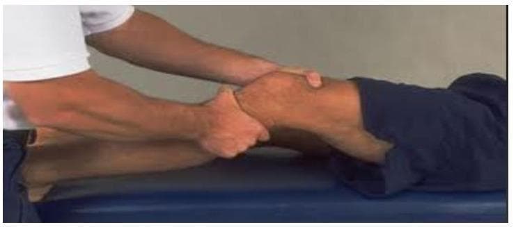 This clinical photograph demonstrates the performance of the Lachman test, a primary physical examination maneuver used to assess the integrity of the anterior cruciate ligament (ACL). The image shows a patient in the supine position with the knee joint passively flexed to approximately 20-30 degrees. The examiner’s hands are strategically positioned for orthopedic assessment: one hand stabilizes the distal femur just superior to the patella, while the other hand grasps the proximal tibia at the level of the tibial tuberosity. The procedure involves applying a brisk anterior force to the tibia relative to the femur to evaluate for anterior translation and the quality of the 'end-point' resistance. Increased laxity or a soft end-point indicates a potential ACL tear. This visual is representative of clinical orthopedic and sports medicine evaluations, serving as a pedagogical tool for teaching physical diagnosis of knee instability.