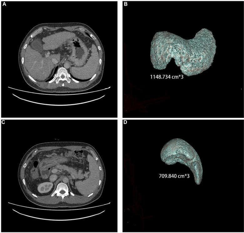 This composite medical image displays abdominal computerized tomography (CT) scans and corresponding 3D volumetric reconstructions of the liver and spleen from a 44-year-old male with chronic hepatitis B cirrhosis. Panels A and C show axial CT slices of the upper abdomen; Panel A highlights the liver in the right upper quadrant, while Panel C focuses on the spleen in the left upper quadrant. Panels B and D present the 3D rendered models used for volumetric quantification. The liver (Panel B) is shown with a calculated volume of 1148.734 cm³ and exhibits a nodular surface morphology characteristic of cirrhotic changes. The spleen (Panel D) has a calculated volume of 709.840 cm³, demonstrating significant splenomegaly, a common secondary finding in portal hypertension related to cirrhosis. These images illustrate the use of thin-slice CT data and specialized workstations for precise organ volumetry in the longitudinal management of chronic liver disease.