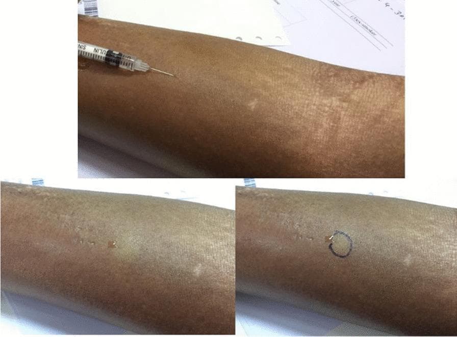 A series of three clinical photographs demonstrating the procedural steps of a Tuberculin Skin Test (TST), specifically utilizing the Mantoux technique. The image sequence illustrates the administration of purified protein derivative (PPD) on the volar aspect of the forearm in a patient with systemic sclerosis. The first frame shows a tuberculin syringe with a needle inserted at a shallow angle for intradermal injection. The second frame depicts the immediate result: the formation of a discrete, pale, raised wheal approximately 6–10 mm in diameter, indicating correct superficial placement. The third frame shows the site after a circular mark has been drawn around the wheal's perimeter to facilitate localized identification for follow-up interpretation. The skin of the patient shows characteristic features of systemic sclerosis, including localized hypopigmentation and a taut, thickened texture. This visual serves as an educational guide for infectious disease screening and diagnostic dermatology, emphasizing proper technique and the specific challenges of skin testing in patients with scleroderma.