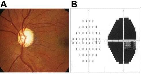 This composite educational graphic illustrates clinical findings of primary open-angle glaucoma (POAG). Panel A is a fundus photograph of the right eye displaying characteristic glaucomatous optic disc atrophy. Visible pathological features include significant enlargement of the optic cup (increased cup-to-disc ratio), thinning of the neuroretinal rim, and generalized disc pallor, suggesting advanced optic nerve damage. Panel B presents the corresponding visual field test (automated perimetry) results. The greyscale plot reveals extensive scotomas or visual field defects in the right eye, characterized by a large darkened area indicative of profound sensitivity loss. The pattern demonstrates significant functional impairment, such as quadrantanopia or arcuate-style defects, consistent with severe glaucomatous neuropathy. This material serves to demonstrate the clinical correlation between anatomical structural damage to the optic nerve head and subsequent functional vision loss in ophthalmic patients.