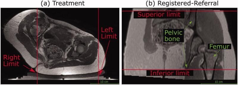 This figure displays two magnetic resonance imaging (MRI) views of the pelvic region, labeled (a) Treatment and (b) Registered-Referral, illustrating transducer translation restrictions for MR-guided High Intensity Focused Ultrasound (MRgHIFU). Image (a) shows an axial cross-section of the pelvis and thighs. Vertical red lines indicate 'Left Limit' and 'Right Limit,' which define the lateral boundaries for transducer movement based on the extent of acoustic coupling between the patient's skin and the gel pad. Image (b) shows a coronal view where anatomical structures including the pelvic bone and femur are labeled. Horizontal red lines denote the 'Superior limit' and 'Inferior limit,' which restrict vertical transducer translation based on the anatomical coverage of the pelvic bone and the full body outline. These boundaries are critical for treatment planning to ensure safe and effective sonication while respecting the physical range of the robotic positioner and the limits of the acoustic coupling interface.