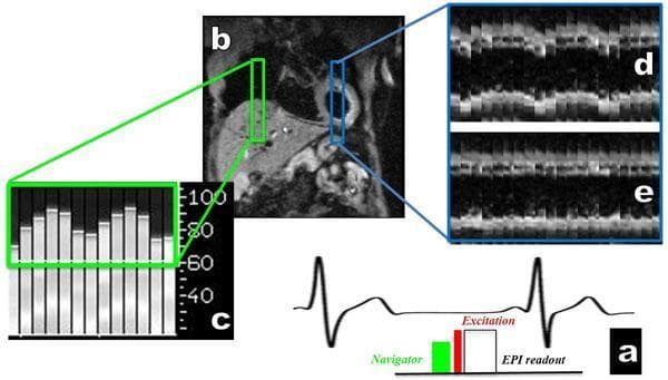 This composite educational image illustrates the methodology and results of respiratory motion compensation in abdominal Magnetic Resonance Imaging (MRI). Panel (a) shows a schematic diagram of a pulse sequence, including a pencil-beam navigator, excitation pulse, and Echo Planar Imaging (EPI) readout synchronized with a respiratory cycle. Panel (b) is a coronal MRI scout image of the liver showing the placement of the navigator on the superior dome. Panel (c) displays a bar graph of navigator signals representing real-time diaphragmatic displacement. Panels (d) and (e) provide a side-by-side comparison of coronal diffusion-weighted images (b=30 s/mm2) acquired over one minute. Image (d) shows significant respiratory motion artifacts, appearing as jagged, discontinuous horizontal bands. In contrast, image (e) demonstrates the efficacy of 'slice following' motion correction, exhibiting smoother, more linear continuity and improved image stability. This content is designed for medical physics and radiology education, focusing on respiratory gating techniques and motion artifact reduction in abdominal imaging.