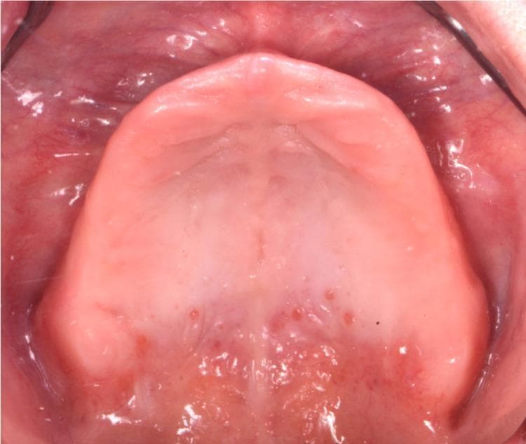 This clinical intraoral photograph provides an occlusal view of an edentulous maxilla, demonstrating significant alveolar ridge resorption consistent with Class III edentulism. The image shows the maxillary alveolar ridge and hard palate. The alveolar mucosa is generally healthy and pink, though the keratinized gingiva covering the crest of the ridge appears thin. In the anterior region of the ridge, several discrete, small erythematous spots are visible, which may indicate mild irritation or chronic atrophic candidiasis (denture stomatitis), given the history of long-term denture wear. Anatomical structures such as the median palatine raphe and palatal rugae are visible but appear somewhat flattened due to tissue atrophy. The surrounding vestibular mucosa appears moist and adequately vascularized. This image is used in prosthodontic education to illustrate the anatomical challenges of severe bone atrophy and the evaluation of soft tissue health prior to fabricating new complete dentures.