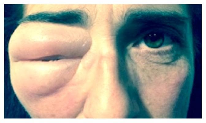 This clinical photograph displays a frontal view of a patient's face, highlighting severe unilateral edema of the right eyelid. The right periorbital region is markedly swollen, causing complete mechanical ptosis as the upper and lower eyelids meet, effectively obscuring the palpebral fissure and the globe. The skin over the edematous area appears stretched, smooth, and tense, but lacks signs of acute inflammation such as erythema or visible cutaneous lesions. In contrast, the left eye appears normal with a fully visible palpebral fissure, iris, and pupil, emphasizing the significant facial asymmetry. This visual presentation is characteristic of localized fluid accumulation or herniation in the orbital area, often requiring diagnostic imaging to differentiate between inflammatory processes, trauma-related cerebrospinal fluid (CSF) leaks, or orbital tumors. This image serves as an educational example for ophthalmological and emergency medicine assessment of periorbital swelling.