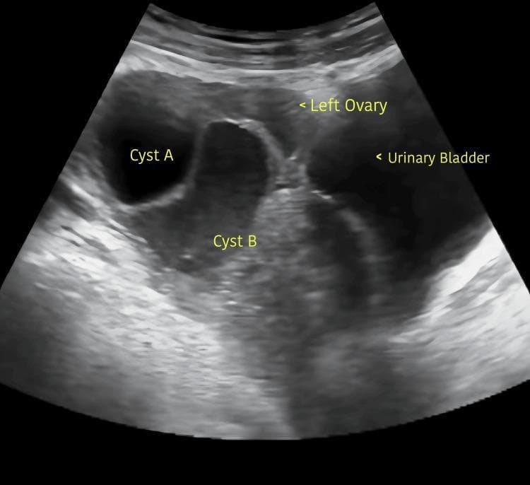 This diagnostic image is a transabdominal pelvic ultrasound demonstrating bilateral ovarian enlargement due to multicystic masses, specifically focused on the left ovary. Two distinct cystic structures are identified and labeled. Cyst A is a smaller, well-defined, simple anechoic cyst with smooth, thin borders and no internal septations or solid components. Cyst B is significantly larger, predominantly anechoic with some irregular internal echoes or artifacts, and appears less circumscribed than Cyst A. Anatomical landmarks labeled include the 'Left Ovary' and the 'Urinary Bladder' situated at the periphery. The ultrasound findings are consistent with ovarian hyperstimulation or multicystic ovaries, demonstrating significant volume increase in the adnexal structures. This visual is intended for educational use in obstetrics and gynecology to illustrate sonographic characteristics of simple versus complex ovarian cysts and pelvic anatomy under pathological conditions.