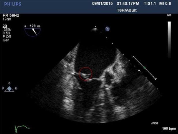 This diagnostic image is a 2D Transesophageal Echocardiogram (TEE) in an adult patient, focused on the mitral valve apparatus. The image shows a cross-sectional view of the heart chambers where the mitral valve leaflets are visible. Circled in red is a distinct, hyperechoic, and irregular mobile mass attached to the atrial side of a mitral valve leaflet, highly characteristic of infective endocarditis vegetation. The surrounding cardiac structures show typical ultrasound echogenicity, though there is some posterior acoustic shadowing that limits visualization of the distal myocardial segments. The primary clinical significance is the demonstration of valvular vegetation in the setting of suspected systemic infection, providing a key diagnostic finding for infective endocarditis. The image is optimized for cardiology and infectious disease education, illustrating the morphological appearance of pathological valvular attachments.