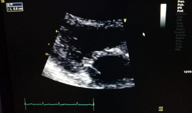 This diagnostic image is a transthoracic echocardiogram (TTE) in a parasternal long-axis view, demonstrating a case of native mitral valve infective endocarditis. The image shows the heart's internal structures with varying echogenicity: the myocardium appears relatively hypoechoic (darker gray), while the mitral valve leaflets are more echogenic (brighter). A distinct, highly echogenic, linear structure representing a vegetation is visible attached to the atrial surface of a mitral valve leaflet. On-screen calipers measure this vegetation at approximately 0.8 cm in length. The vegetation exhibits an irregular morphology and is located centrally in the valvular apparatus between the left atrium and left ventricle. An electrocardiogram (ECG) tracing is visible at the bottom of the frame for temporal orientation during the cardiac cycle. This visual evidence serves as a primary diagnostic criterion for infective endocarditis, illustrating the characteristic appearance of mobile vegetations on cardiac valves via ultrasound imaging.