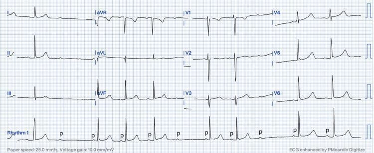 A standard 12-lead electrocardiogram (ECG) displayed on a traditional grid background with a continuous rhythm strip (Rhythm 1) along the bottom. The tracing illustrates Mobitz type II second-degree atrioventricular (AV) block. The diagnostic hallmark is visible in the rhythm strip: regular P waves are present, but there is an abrupt failure of AV conduction where a P wave (labeled with lowercase 'p') is not followed by a QRS complex. Unlike Mobitz type I (Wenckebach), the conducted beats show a constant and normal PR interval without progressive lengthening prior to the dropped beat. The ECG shows a slow heart rate (bradycardia) consistent with intermittent 2:1 or high-grade AV block. Waveform morphology includes narrow QRS complexes, suggesting the block is likely occurring at the level of the AV node or the Bundle of His. This clinical photograph serves as an educational tool for identifying advanced cardiac conduction system disease and distinguishing between subtypes of second-degree heart block in a clinical or obstetric setting.