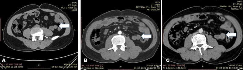 This diagnostic image is a triple-phase axial computed tomography (CT) scan of the lower abdomen, demonstrating a vascular malformation in the small bowel. The image is divided into three panels representing different contrast phases: (A) non-contrast (NCCT), (B) arterial phase, and (C) portal venous phase. Each panel shows the central lumbar vertebral body, paraspinal musculature, and abdominal cavity containing loops of bowel. White arrows in each phase point to a specific bowel loop in the left quadrant. In the non-contrast phase (A), the target loop is isodense to surrounding soft tissue. In the arterial phase (B), there is subtle hyperattenuation indicating early filling of a vascular lesion. In the portal venous phase (C), the enhancement becomes significantly more pronounced and radio-dense, characteristic of a slow-flow vascular malformation or hemangioma that fills over time. This sequence illustrates the importance of multiphase imaging in identifying mucosal vascular ectasias and angioectasias, which are key clinical considerations in patients presenting with obscure gastrointestinal bleeding or melena.
