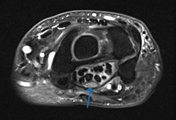 This diagnostic image is an axial T2-weighted fluid-sensitive MRI scan of the human wrist at the level of the carpal tunnel. The primary focus is the median nerve, indicated by a blue arrow, which demonstrates significant pathological changes characteristic of Carpal Tunnel Syndrome (CTS). The nerve is visibly thickened and displays an abnormally high signal intensity (hyperintensity), consistent with intraneural edema. It is positioned superficially within the carpal tunnel, just deep to the flexor retinaculum and palmar to the dark, hypointense circular bundles representing the flexor tendons (flexor digitorum superficialis, profundus, and flexor pollicis longus). The surrounding carpal bones form the osseous boundaries of the tunnel. This image serves as a clinical illustration of nerve compression, highlighting key radiological markers used in the diagnosis of entrapment neuropathies: increased cross-sectional area and edema-induced signal changes in the median nerve.