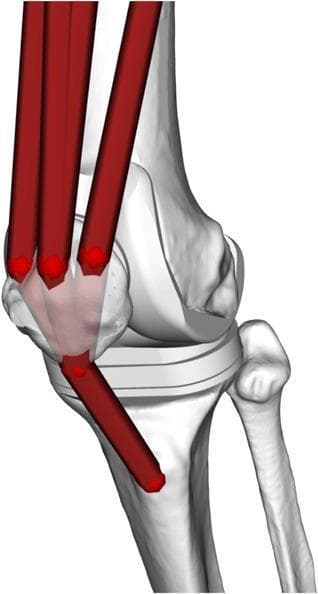 This musculoskeletal model illustrates the biomechanics of the knee joint, specifically focusing on the extensor mechanism. The anatomical diagram features a schematic 3D rendering of the distal femur, proximal tibia, fibula, and patella. Red cylindrical vectors represent the Hill-type musculotendon units of the quadriceps femoris. These muscle representations originate superiorly and converge to insert onto the superior aspect of the patella. A single red vector extends from the inferior pole of the patella to the tibial tuberosity, representing the patellar ligament. The model demonstrates the patella's role as a fulcrum or frictionless pulley, transmitting forces from the quadriceps to the tibia to facilitate knee extension. A prosthetic spacer or tibial component is visible between the femoral condyles and the tibial plateau, suggesting the model is configured for post-operative orthopedic analysis or total knee arthroplasty (TKA) simulation. This visualization is used in biomechanical engineering to estimate joint contact forces and limb dynamics.