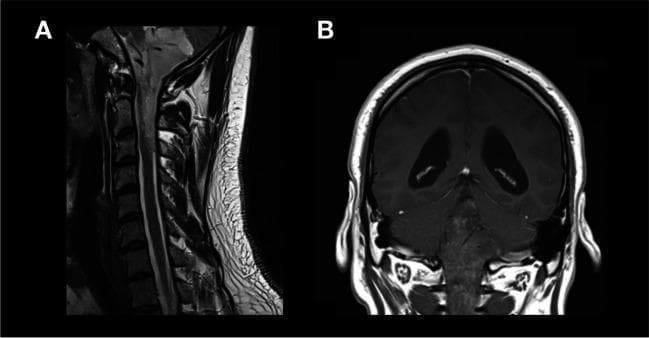 This composite diagnostic image features two MRI views (labeled A and B) demonstrating a neurosurgical case involving a posterior fossa tumor with spinal extension. Image A is a T2-weighted sagittal MRI of the cervical and upper thoracic spine. It shows the vertebral bodies, intervertebral discs, and the spinal cord. A hyperintense lesion or signal abnormality is visible extending inferiorly from the posterior fossa into the spinal canal, reaching the C1-C2 level, consistent with tumor extension. Image B is a T1-weighted coronal MRI of the brain. It illustrates significant ventriculomegaly, with prominent enlargement of the lateral ventricles. The brain parenchyma shows multiple small punctate hyperintensities, and there is evident enhancement around the cerebral hemispheres. Collectively, these images illustrate the preoperative planning for an extended craniotomy with C1-C2 laminotomy, aimed at resecting a tumor (such as an ependymoma) that originates in the fourth ventricle and extends into the upper cervical spinal canal.