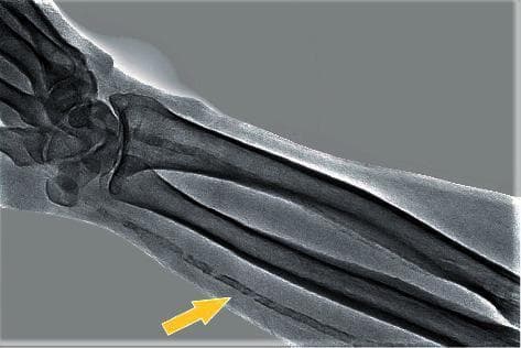 This diagnostic image is a plain radiograph of the distal forearm and wrist, demonstrating significant vascular pathology. The skeletal anatomy, including the radius, ulna, and carpal bones, serves as a reference for the prominent finding: diffuse calcification of the radial artery (indicated by a yellow arrow). The calcification presents as a continuous, linear, and somewhat beaded pattern of increased radiopacity tracing the anatomical course of the radial artery. This visual appearance is characteristic of Monckeberg medial calcific sclerosis (mediocalcinosis), where calcium deposits accumulate in the tunica media of the arterial wall. Unlike intimal atherosclerosis, which often presents with eccentric plaques, this medial calcification is typically non-obstructive but leads to increased arterial stiffness. This condition is frequently associated with advanced age, diabetes mellitus, and end-stage renal disease. The contrast between the dense cortical bone and the less dense, fragmented radiopacity of the calcified vessel highlights the extent of the vascular mineralization throughout the visible length of the forearm.