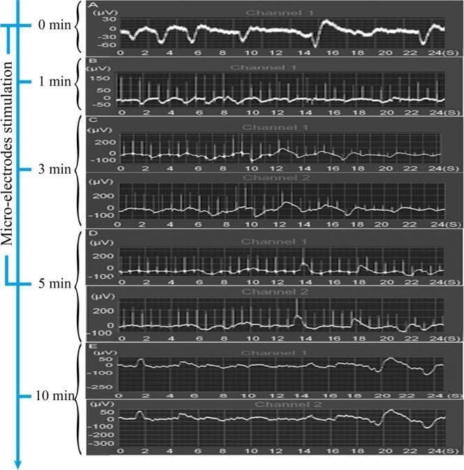 This physiological timeline illustrates the real-time measurement of electric potential in sympathetic nerve fibers using a multiple physiologic recorder. The figure contains five panels (A-E) tracking changes in voltage (µV) over time (seconds) across two channels (Channel 1: left; Channel 2: right). (A) Baseline resting state at 0 minutes shows low-amplitude fluctuations between -60 µV and 30 µV. (B-D) During microelectrode stimulation at 1, 3, and 5-minute intervals, there is a progressive increase in spike frequency and voltage range, with peaks reaching approximately 200 µV and lows near -100 µV. Consistency between Channel 1 and Channel 2 indicates a systemic or bilateral sympathetic response to localized stimulation. (E) 5 minutes after ceasing stimulation (the 10-minute total mark), the electric potential demonstrates a marked decrease in amplitude and frequency, returning toward a more stable state with reduced peak values (max ~50 µV). This series demonstrates the transient excitatory effect of microelectrode stimulation on sympathetic nerve fiber activity and its potential clinical application in modulating autonomic influence on tissue healing.