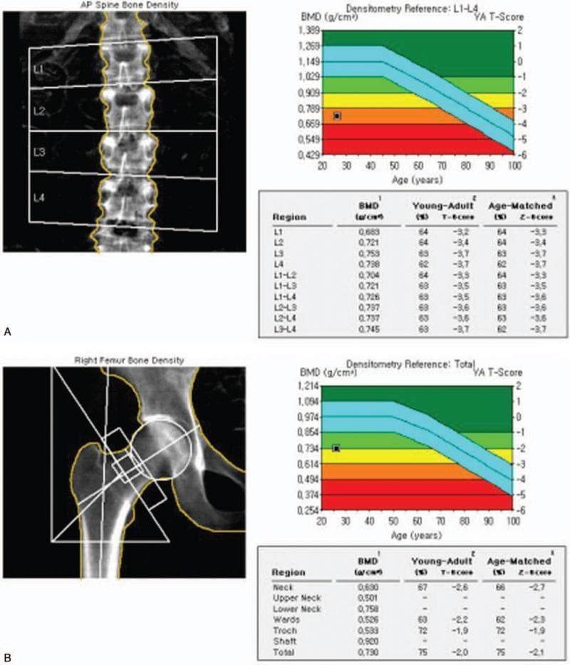 This diagnostic visual comprises two dual-energy X-ray absorptiometry (DXA) scan reports, labeled A and B, assessing bone mineral density (BMD). Panel A displays an anteroposterior (AP) view of the lumbar spine (L1-L4). It includes the scout image with vertebrae segmentation, a densitometry reference graph, and a data table. The graph plots the patient's BMD against age-matched reference ranges, showing a data point in the red zone (high fracture risk). The L1-L4 combined T-score is -3.5, indicating significant osteoporosis. Panel B illustrates a DXA scan of the right femur, including the femoral neck and total hip regions. The corresponding graph shows the patient's data point in the yellow-to-orange osteopenic/osteoporotic threshold, with a total hip T-score of -2.0 and a femoral neck T-score of -2.6. Both reports provide detailed metrics including BMD (g/cm²), Young-Adult T-scores, and Age-Matched Z-scores for multiple sub-regions, serving as a clinical standard for diagnosing bone density disorders and evaluating fracture risk.