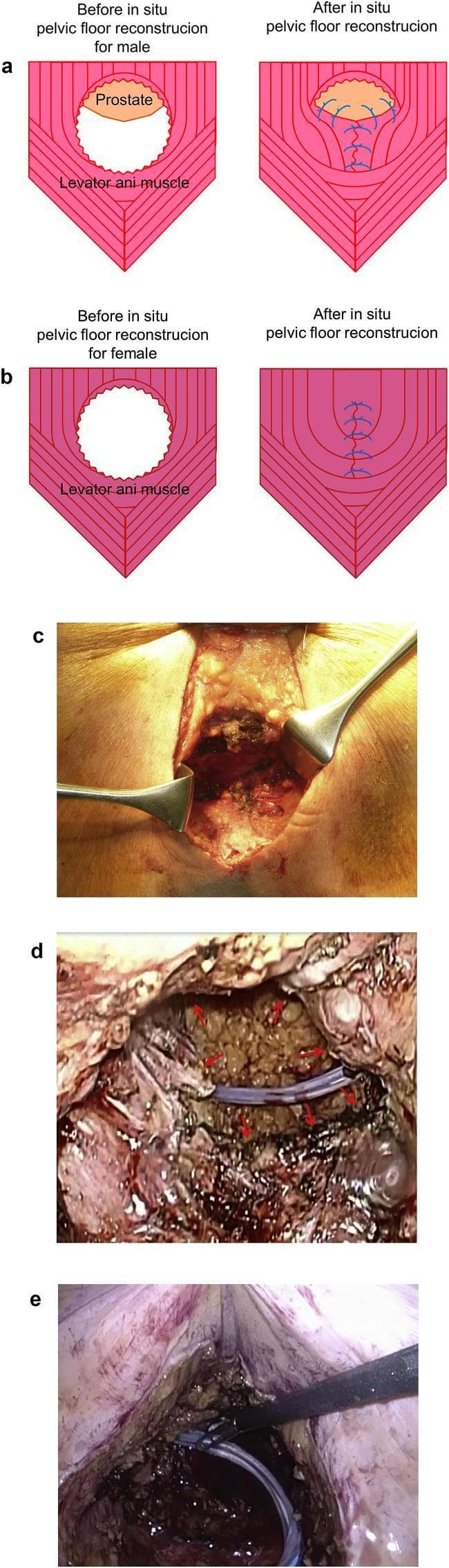 This multi-panel figure illustrates surgical techniques and intraoperative findings for in situ pelvic floor reconstruction following perineal surgery. Panels (a) and (b) are anatomical diagrams showing the schema for levator ani muscle closure in male and female patients, respectively. The male diagram highlights the relationship between the levator ani and the prostate, showing the placement of sutures to bridge the pelvic defect. Panel (c) is a clinical photograph of the perineal surgical site, with metal retractors exposing a deep pelvic wound where sutures are applied to the levator ani muscle. Panels (d) and (e) provide laparoscopic views of the pelvic cavity. Panel (d) shows the pelvic floor prior to closure, with arrows identifying the unsutured levator ani muscle and a visible intra-abdominal drainage tube. Panel (e) depicts the same surgical field after levator ani closure, showing the reconstructed pelvic floor, the drainage tube in situ, and surgical instruments used for manipulation. The content is designed for surgical education regarding pelvic floor integrity and hernia prevention post-resection.