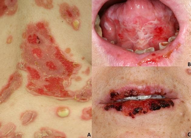 This composite of clinical photographs illustrates the mucocutaneous manifestations of pemphigus variants. Panel A (top left) displays Pemphigus vulgaris on the skin, showing large, irregular, erythematous erosions with peripheral peeling of the epidermis, consistent with ruptured flaccid blisters. A small, intact flaccid vesicle with yellowish fluid is visible in the lower quadrant. Panel B (top right) demonstrates oral involvement in Pemphigus vulgaris, featuring multiple painful-looking erosions and white macerated plaques on the ventral surface of the tongue and labial mucosa. Panel C (bottom right) showcases Paraneoplastic pemphigus, characterized by severe stomatitis with diffuse, hemorrhagic crusting and deep erosions across the entire vermillion border of the upper and lower lips. These images contrast the typical cutaneous and oral erosions of Pemphigus vulgaris with the more severe, hemorrhagic labial involvement often seen in paraneoplastic variants, serving as a diagnostic tool for identifying autoimmune blistering diseases and their clinical severity.