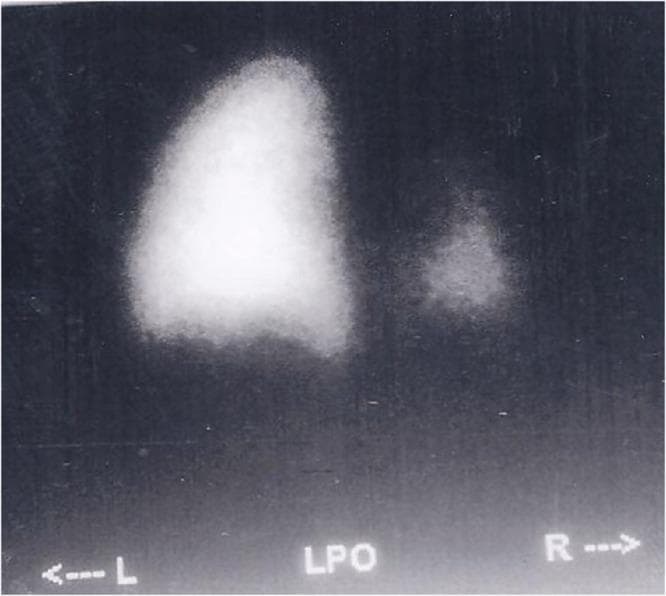 A diagnostic nuclear medicine image depicting a Ventilation-Perfusion (V/Q) scan, specifically in the Left Posterior Oblique (LPO) view as indicated by the label. The scan displays the radioisotope distribution within the lungs. The left lung (labeled 'L') appears physiologically normal with a well-defined, vertically elongated shape and homogeneous high-intensity tracer uptake across the upper, middle, and lower zones. In contrast, the right lung (labeled 'R') demonstrates significant pathology characterized by marked hypoplasia or a perfusion/ventilation defect. This region is substantially smaller, more rounded, and exhibits much lower signal intensity compared to the left side. The lower zone of the right lung is notably absent or poorly visualized, consistent with a hypoplastic lower lobe or a severe segmental defect. This imaging is utilized in pulmonology and radiology to assess pulmonary vascularity, ventilation efficiency, and congenital or acquired thoracic abnormalities.