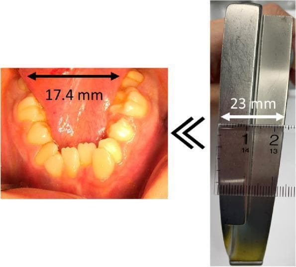 A composite clinical comparison image demonstrating a mismatch between oral anatomy and standard medical equipment. The left panel shows a clinical photograph of a patient's lower dental arch exhibiting severe dental arch stenosis, significant crowding, and misalignment of the mandibular teeth. An overlay indicates an intra-arch distance of 17.4 mm between the mandibular second molars. The right panel displays a metallic Macintosh laryngoscope blade #3, with a superimposed ruler measuring its width at 23.0 mm. A double chevron symbol between the images highlights that the patient's dental arch width is smaller than the laryngoscope blade. This comparison illustrates a physical barrier to conventional direct laryngoscopy, highlighting a predictor for difficult airway management and the need for alternative intubation techniques, such as video laryngoscopy, in patients with Moebius syndrome or similar craniofacial abnormalities.