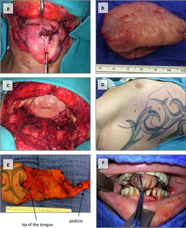 This composite of clinical photographs documents a surgical sequence of total glossectomy and subsequent microvascular reconstruction in a patient with recurrent squamous cell carcinoma. Image A shows the tumor involving the base of the tongue, demarcated by a midline indicator. Image B depicts the gross resected tongue specimen. Image C captures the surgical field post-resection via a transcervical approach, highlighting the exposed mandible and palate within the oral cavity. Images D and E illustrate the donor site and the harvested right-sided myocutaneous serratus anterior free flap (SAFF). The flap includes a skin island, anatomical markers for the neo-tongue tip, and the vascular pedicle. Image F displays the final intraoperative result, showing the reconstructed 'neo-tongue' positioned within the oral cavity and sutured to the remaining oral mucosa. This series serves as an educational resource for head and neck oncology, demonstrating tumor resection margins, flap design for functional reconstruction, and transcervical surgical access.