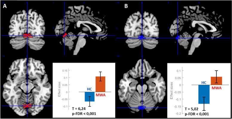 This diagnostic image displays resting-state functional MRI (rs-fMRI) seed-to-voxel connectivity analysis results for patients with migraine with aura (MWA). The visual is divided into two sections, A and B, each showing three orthogonal brain views (coronal, sagittal, and axial) and an accompanying bar graph. Section A illustrates increased functional connectivity between the right antero-dorsal insula (ROI 1 R) and a posterior cluster colored in red/orange. Section B illustrates increased functional connectivity between the left antero-dorsal insula (ROI 1 L) and a similar cluster colored in blue. Blue crosshairs in both sections localize the primary cluster to the cerebellar vermis (Vermis VI/VII) and the lingual gyrus. The bar graphs compare 'Effect Sizes' between Healthy Controls (HC) and Migraine with Aura (MWA) patients, indicating significantly higher connectivity in the MWA group (p-FDR < 0.001). Anatomical landmarks visible include the cerebral cortex, corpus callosum, brainstem, and cerebellar hemispheres. This image is used to demonstrate neuro-pathophysiological differences in functional brain networks associated with migraine disorders.