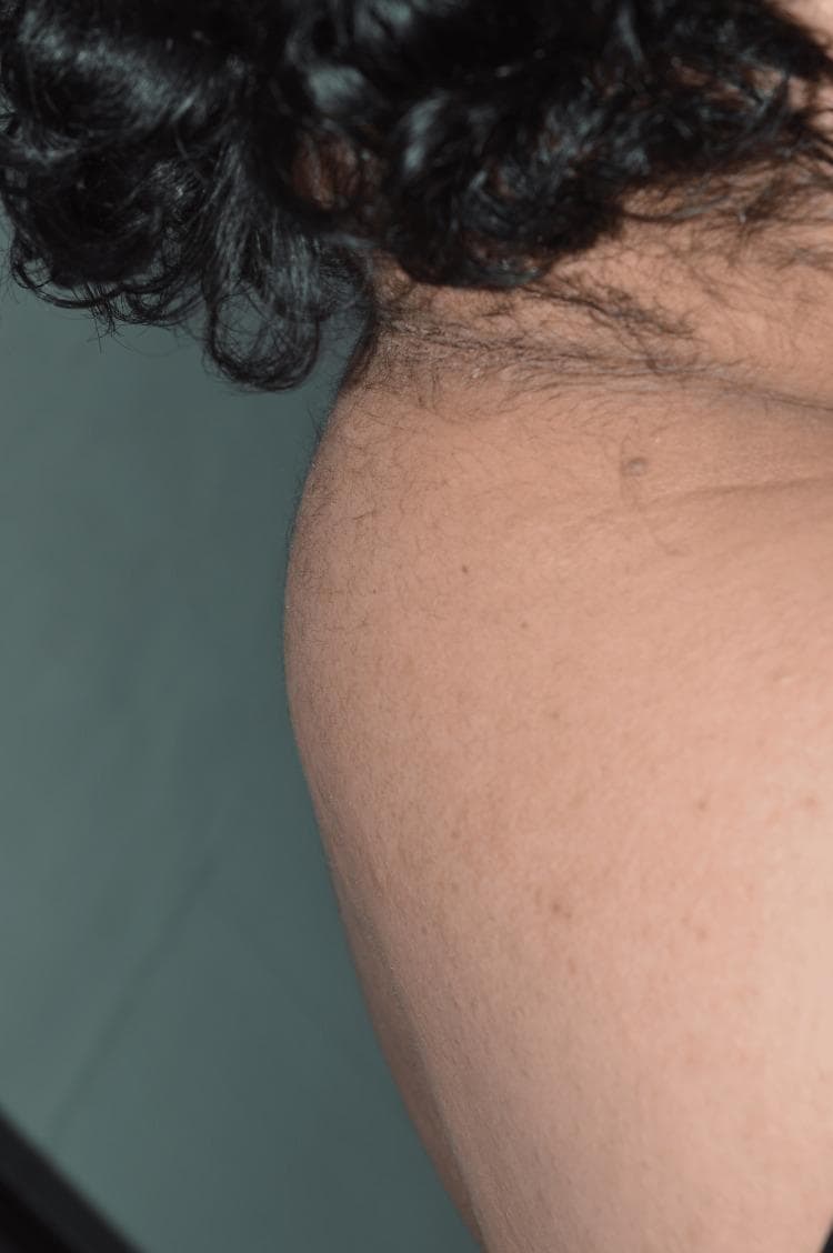 This clinical photograph shows a lateral view of the posterior neck and upper back of a patient, demonstrating a prominent dorsocervical fat pad, commonly referred to as a 'buffalo hump.' The anatomical region involved is the posterior cervicothoracic junction, specifically overlying the C7-T1 vertebrae. The growth is characterized by a rounded, localized accumulation of adipose tissue that protrudes posteriorly, altering the natural contour of the neck and upper spine. The overlying skin appears intact with visible fine terminal hairs and follicular orifices, typical of the nuchal region. No acute inflammatory signs, ulceration, or primary skin lesions are visible on the surface of the fat pad. This clinical finding is frequently associated with metabolic disturbances, hypercortisolism (Cushing's syndrome), or certain pharmacological side effects, such as those seen in antiretroviral therapy for HIV. The image serves as an educational example of abnormal fat distribution (lipodystrophy) in a clinical diagnostic context.