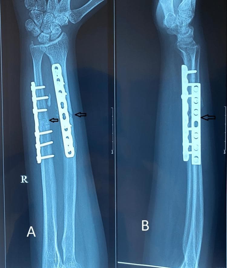 This diagnostic image consists of two radiographic views (anteroposterior, A; lateral, B) of a right forearm, three months post-operative. The radiographs demonstrate surgical internal fixation of both the radius and ulna using metallic compression plates and screws. A dynamic compression plate (DCP) is visible on the distal-to-mid shaft of the radius, secured with five cortical screws. A similar, shorter plate is affixed to the ulna, secured with five screws. Black arrows indicate the primary fracture sites on both bones. These sites show evidence of progressive fracture union characterized by bridging callus formation and increased radio-opacity, indicating biological consolidation. The surrounding soft tissues appear unremarkable, and the alignment of the radial and ulnar shafts is well-maintained. This image is an educational example of orthopedic fracture management using open reduction and internal fixation (ORIF) and the assessment of secondary bone healing in a clinical follow-up setting.