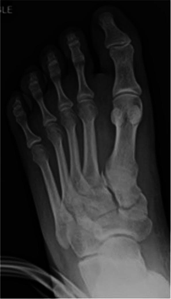 Anteroposterior (AP) radiograph of a human left foot illustrating a Lisfranc joint injury. The image displays a disruption of the normal alignment at the tarsometatarsal (TMT) joints. A key finding is the pathognomonic 'fleck' sign, characterized by a small bony avulsion fragment located in the space between the base of the second metatarsal and the medial cuneiform, signifying an avulsion of the Lisfranc ligament. There is a visible widening of the interval (diastasis) between the first and second metatarsal bases, alongside lateral displacement of the second through fifth metatarsals relative to the tarsal bones. The diagnostic focus is the evaluation of midfoot stability and the integrity of the tarsometatarsal complex. This radiographic view is essential for identifying fracture-dislocations of the midfoot columns, often resulting from high-energy axial loading or hyper-plantarflexion injuries.
