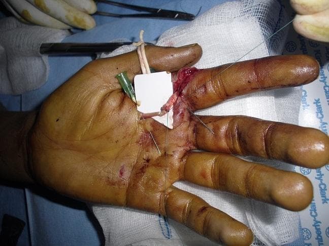 This clinical photograph captures an intraoperative view of an orthopedic surgical procedure on a human hand, specifically a flexor tendon repair in Zone II (the 'no man's land' of the hand). The image demonstrates the Kessler suture technique, a core suture method used to provide high tensile strength during tendon end-to-end anastomosis. Visible pathology includes a significant laceration across the base of the index finger and the distal palmar crease, with exposed underlying soft tissue and minor hemorrhage. Surgical instrumentation is present, including hypodermic needles used as temporary transfixion pins to stabilize the tendon ends and a white protective plate or background material used to isolate the surgical site. A rubber band traction system is also visible, likely part of a dynamic splinting or mobilization protocol (such as the Kleinert or Duran technique) to prevent post-operative adhesions. This visual is highly relevant for hand surgery education, specifically regarding primary flexor tendon reconstruction and intraoperative stabilization methods.