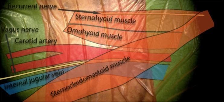 This surgical anatomy diagram illustrates the anatomical layers and key structures of the anterior neck. The image features a translucent overlay on what appears to be a clinical specimen or high-fidelity model to highlight vascular, neural, and muscular relationships relevant to anterior cervical spine surgery. Labeled muscular structures include the superficial sternocleidomastoid muscle (SCM) and the deeper strap muscles: the sternohyoid and omohyoid muscles. Medial to the SCM, the carotid sheath contents are depicted, including the carotid artery (red), internal jugular vein (blue), and the vagus nerve. Furthermore, the recurrent laryngeal nerve is shown in its characteristic course. This educational visual emphasizes the spatial orientation of superficial, middle, and deep cervical fascia layers, specifically demonstrating how the strap muscles and major vessels are positioned relative to the midline and the surgical corridor used for procedures such as anterior cervical discectomy and fusion (ACDF).