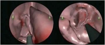 This Virtual Reality (VR) surgical simulation image displays two endoscope-view frames of the sinonasal cavity during Functional Endoscopic Sinus Surgery (FESS) tasks. The left frame illustrates an ethmoidectomy, showing the computer-rendered pinkish-white mucosal surfaces of the ethmoid air cells. A microdebrider, characterized by its gray shaft and dark suction-cutting tip, is seen interacting with the soft tissue within the narrow surgical corridor. The right frame illustrates a sphenoidotomy, showing a wider cavity corresponding to the sphenoid sinus. Both views utilize a 0-degree endoscope perspective and include small green vertical indicators on the periphery for orientation. Reddish shading on the virtual mucosa mimics clinical tissue manipulation or minor hemorrhage. This simulation material is designed for Otolaryngology (ENT) education to train medical students and residents on the anatomical landmarks and instrument handling required for safe sinus surgery, specifically focusing on the microdebrider's use near critical structures like the skull base and lamina papyracea.