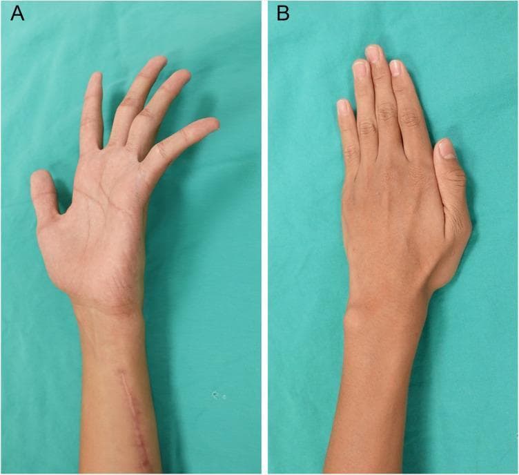 This clinical photograph shows a side-by-side comparison of a left hand and forearm following surgical treatment for ulnar neuropathy. Image A displays the hand in a volar view, highlighting a persistent ulnar claw hand deformity where the 4th and 5th fingers exhibit hyperextension at the metacarpophalangeal joints and flexion at the interphalangeal joints. A linear surgical scar is visible on the distal volar forearm. Image B displays the dorsal view of the same hand six months postoperatively, demonstrating a complete resolution of the claw deformity. The 4th and 5th fingers now maintain a neutral, extended posture aligned with the other digits. There is no visible atrophy of the intrinsic hand muscles or hypothenar eminence, indicating successful reinnervation or functional recovery. This comparison illustrates the clinical outcomes of ulnar nerve repair or transfer in a pediatric patient following traumatic injury and subsequent nerve palsy.
