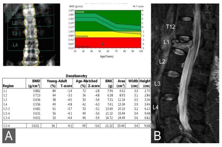 Educational medical composite image illustrating diagnostic findings of osteoporosis and an associated vertebral compression fracture. Panel A displays a Dual-Energy X-ray Absorptiometry (DEXA) report including a coronal lumbar spine scan (L1-L4), a densitometry table showing a critical T-score of -4.8 at L4, and a corresponding bone mineral density (BMD) graph. The graph plots BMD (g/cm²) against age, with color-coded reference ranges: green for normal, yellow for osteopenia, and red for osteoporosis; the patient's data point falls significantly within the osteoporosis range. Panel B presents a sagittal view MRI of the lumbar spine using a Short Tau Inversion Recovery (STIR) sequence. The MRI reveals a wedge-shaped deformity and hyperintense signal at the L1 vertebral body, characteristic of bone marrow edema from an acute osteoporotic compression fracture. Normal rectangular morphology is maintained in T12 and L2-L4. This visual set demonstrates the correlation between quantitative bone density measurements and clinical pathology in geriatric orthopedics.