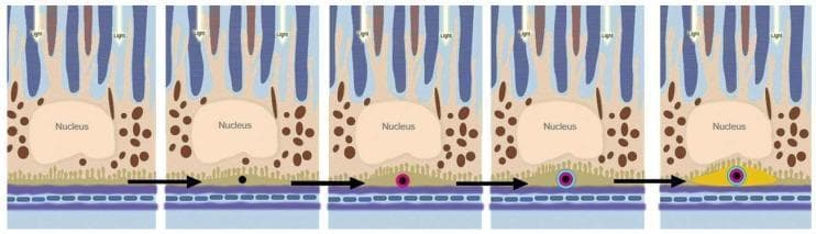 This pathophysiology diagram illustrates the sequential formation of sub-retinal pigment epithelium (RPE) deposits, a key process in the pathogenesis of Age-Related Macular Degeneration (AMD). The five-panel progression depicts the retinal layers from top to bottom: photoreceptor outer segments receiving light, the RPE cell layer (containing a central nucleus and brown melanocytes), and Bruch's membrane above the choriocapillaris. The metabolic mechanism begins with the appearance of micrometer-sized, black cholesterol-containing extracellular lipid droplets beneath the RPE. The sequence then shows the precipitation of magenta-colored hydroxyapatite (HAP) onto these droplets, followed by the recruitment and binding of blue-colored proteins to the HAP surface. The final panel demonstrates a self-driven oligomerization process resulting in a macroscopic yellow sub-RPE deposit (drusen). This educational model highlights the role of lipid accumulation and mineralization in Bruch's membrane aging and the development of early-stage AMD lesions.