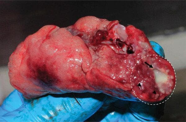 This clinical photograph displays a gross pathological specimen of lung tissue, demonstrating characteristic manifestations of a Mycobacterium tuberculosis infection. The lung parenchyma appears primarily reddish-pink with focal areas of dark red congestion and hemorrhage. A dashed white circle highlights a significant region of granulomatous inflammation. Within this region, a prominent, opaque, whitish-tan mass (indicated by a black arrow) represents a large granuloma, likely containing caseous necrosis. Surrounding this primary lesion, multiple smaller, milliary-sized white nodules (indicated by arrowheads) are scattered throughout the parenchyma, representing smaller granulomas. These visual findings are hallmark macroscopic signs of pulmonary tuberculosis, illustrating the diffuse and localized inflammatory response of the immune system to the bacilli. The specimen demonstrates the typical morphology of granulomatous disease in a primate model, used here for zoonotic research and diagnostic validation.