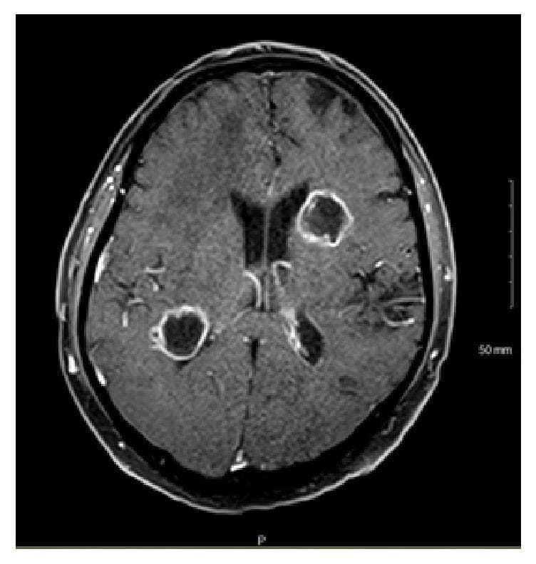 This diagnostic image is an axial T1-weighted magnetic resonance imaging (MRI) of the brain with intravenous contrast. The scan demonstrates multiple well-defined, circular to ovoid lesions within the brain parenchyma. Specifically, one prominent lesion is located in the left corona radiata, and another is visible in the right peritrigonal white matter. Both lesions exhibit characteristic peripheral ring enhancement (rim enhancement) with relatively smooth, uniform borders and central hypointensity, suggestive of liquefactive necrosis or abscess formation. There is evidence of mild perilesional edema around the enhancing margins. These findings are clinically significant in the context of opportunistic infections, such as cerebral aspergillosis or other fungal abscesses, especially in immunocompromised patients. The image serves as a teaching example of differential diagnoses for ring-enhancing intracranial lesions, which include abscesses, metastases, and glioblastoma.
