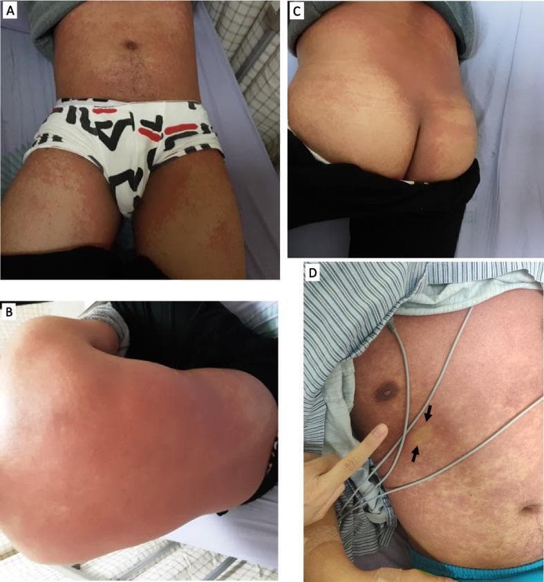 This composite clinical photograph displays a four-panel view (A-D) of an extensive skin rash on a hospitalized patient. Panel A illustrates the anterior trunk and bilateral upper thighs, showing a diffuse, erythematous macular rash with areas of confluence. Panel B shows the posterior trunk, where the rash appears more confluent and intensely erythematous. Panel C depicts the buttocks and lower back, maintaining the same fused macular pattern. Panel D focuses on the anterior chest and abdomen, highlighting the morphology of the rash, which consists of small, reddish, non-pruritic macules. Black arrows in Panel D indicate a specific area of blanching upon digital pressure, a key clinical sign used to differentiate inflammatory erythema from purpura. The distribution is symmetrical and widespread, covering the trunk and limbs while sparing mucous membranes. This visual representation is characteristic of systemic inflammatory responses or drug-related eruptions, such as those associated with atypical infections or hypersensitivity reactions.
