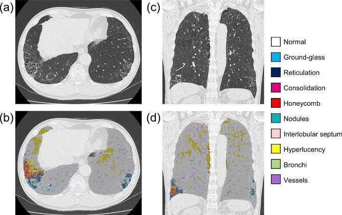 This diagnostic image set displays a comparison between standard high-resolution computed tomography (CT) and Artificial Intelligence Quantitative CT (AIQCT) in a 68-year-old male patient with Chronic Obstructive Pulmonary Disease (COPD) and Interstitial Lung Abnormalities (ILAs). The layout includes axial (a, b) and sagittal (c, d) views. Figures 2a and 2c show conventional CT imaging with visible peripheral reticulations, subpleural honeycombing, and areas of increased opacity. Figures 2b and 2d feature AIQCT overlays that provide automated segmentation and color-coded identification of pulmonary features. According to the included legend, colors represent: red for honeycombing, blue for ground-glass opacity, yellow for hyperlucency (emphysema), pink for consolidation, and dark blue for reticulation. The AIQCT visualization demonstrates a heterogeneous distribution of disease, with hyperlucency predominantly in the upper lobes and fibrotic changes (honeycombing and ground-glass opacities) localized to the lung bases. This tool illustrates the objective quantification of Interstitial Lung Disease (ILD) volume (calculated at 150 mL or 2.90% in this case) for clinical monitoring.