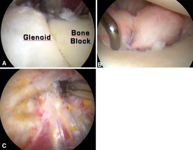 Arthroscopic views of a combined Bristow-Latarjet-Bankart procedure for recurrent anterior shoulder instability. Image A (intra-articular view) shows a coracoid bone graft positioned in a 'standing' orientation, fixed flush with the glenoid surface to restore bone loss; the graft is secured with a cortical screw. Image B demonstrates the associated capsulolabral repair (Bankart repair) where suture anchors are used to reattach the labrum over the bone block, moving the graft to an extra-articular position and enhancing glenoid concavity (bumper effect). Image C (extra-articular view) visualizes the transferred conjoined tendon passing through a split in the subscapularis muscle to provide a dynamic 'sling' or 'belt' effect, reinforcing the anteroinferior capsule. This '2B3' triple-locking technique combines osseous restoration, dynamic soft tissue reinforcement, and labral repair to stabilize the glenohumeral joint.