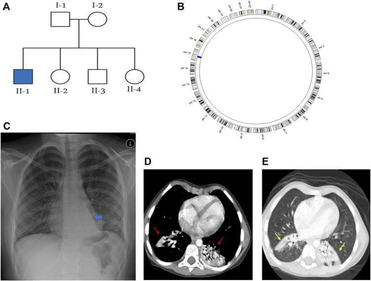 This composite educational image illustrates the genetic and radiological manifestations of Primary Ciliary Dyskinesia (PCD) in a pediatric patient. Panel (A) presents a family pedigree showing an autosomal recessive inheritance pattern. Panel (B) is an AgileMultiIdeogram showing a region of homozygosity (ROH) on chromosome 15. Panel (C) is a posteroanterior (PA) chest X-ray demonstrating a 'flat-waist sign' and a triangular retrocardiac opacity, classic indicators of left lower lobe (LLL) collapse. Panels (D) and (E) are axial CT chest scans in soft-tissue and lung windows, respectively. These diagnostic images reveal bilateral pathology, specifically highlighting subsegmental collapse in both the right and left lower lobes (indicated by red and yellow arrows). The images collectively demonstrate the secondary pulmonary complications of PCD, such as chronic atelectasis and lobar collapse, essential for clinical diagnosis and management in pediatric pulmonology and medical genetics.