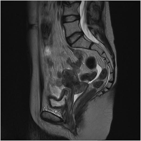 This diagnostic image is a T2-weighted sagittal MRI of the female pelvis, demonstrating a case of post-radiation cervical necrosis. The image provides a lateral view of the pelvic organs, including the uterus, cervix, bladder, and rectum. The primary finding is located at the cervix, which exhibits a highly heterogeneous signal intensity with irregular, poorly defined margins. Areas of hyperintensity are visible, suggesting edema or necroinflammatory exudate, while darker areas may represent tissue breakdown or fibrosis. The anatomical relationship between the bladder (anteriorly) and the rectum (posteriorly) is maintained, though the cervical borders appear distorted compared to normal pelvic anatomy. This visual representation is clinically significant for distinguishing late radiation-induced complications from tumor recurrence in oncology patients. The imaging serves as an educational tool for identifying cervical tissue changes, such as inflammation and structural distortion, following pelvic radiotherapy.
