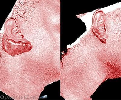 This clinical comparison shows a side-by-side progression of an earlobe keloid before and after CO2 laser treatment, visualized using the Vectra H2 digital vascular filter system. The images are presented in a reddish-tinted digital mode to highlight superficial vascularity. In the 'before' image (left), a large, pedunculated (Type I Chang-Park classification) keloid mass is visible, originating from the inferior aspect of the earlobe. The mass is prominently raised, with an irregular, bumpy texture and high vascular density indicated by darker red pigmentation compared to surrounding skin. The 'after' image (right), taken at a 6-month follow-up, demonstrates significant clinical improvement. There is a substantial reduction in the lesion's volume and height, returning the earlobe to a more anatomical shape. The vascularity appears decreased, evidenced by the lighter, more uniform color intensity across the treated site. This comparison illustrates the efficacy of laser therapy for hypertrophic scarring in dark-skinned patients (phototypes III-VI) and the utility of 3D vascular imaging for monitoring treatment response.